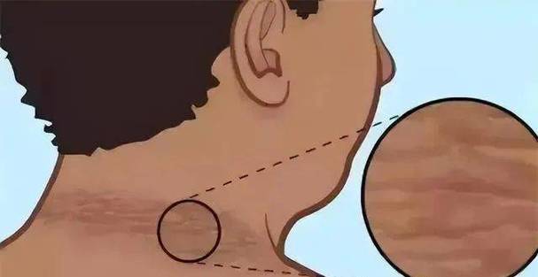 身体有癌，脖子先知？脖子上出现3种迹象，可能是癌症来临的预警