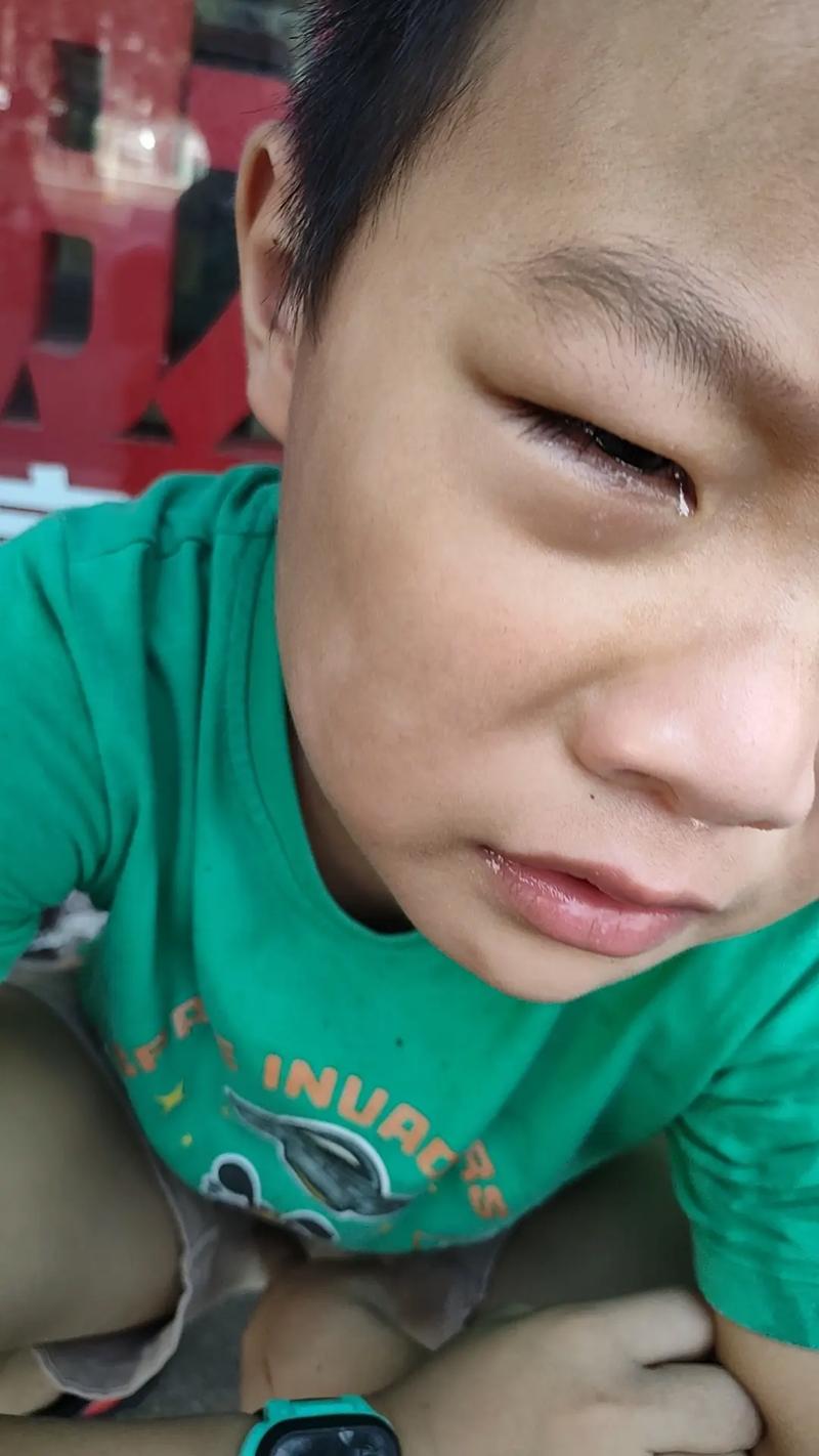翠花好像是中毒了，昨天刚吃了个烂西瓜，今天眼睛就肿的像个烂桃