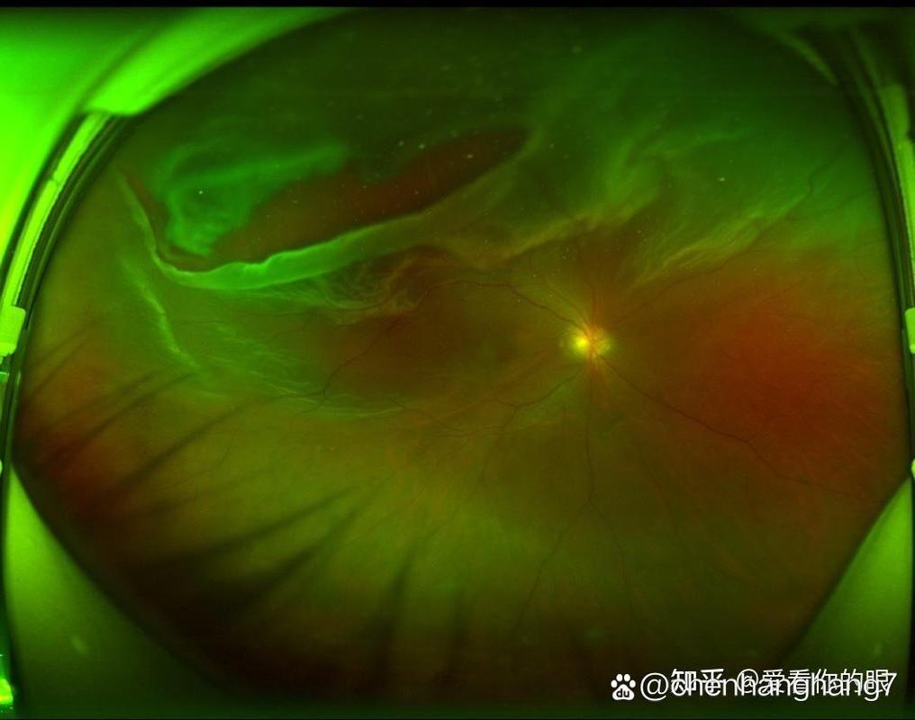 刺激视网膜可让人“看”到全新颜色